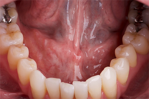 oral cancer screening